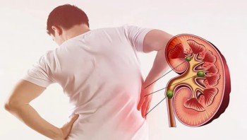 Mẹo Chữa Sỏi Thận Bằng Cây Lá Tự Nhiên: An Toàn, Hiệu Quả Và Dễ Tìm